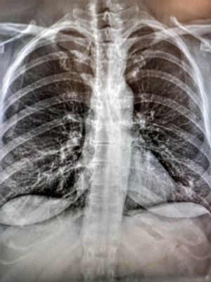 Dnes je svetový deň tuberkulózy, postihnúť môže nielen pľúca, ale aj ďalšie orgány.